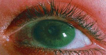 Iritis demonstrating cataract and