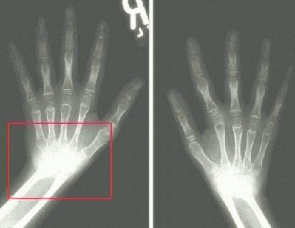 An 8-year-old girl with pauciarticular onset JCA demonstrating destruction of both wrists, subluxation of the carpal