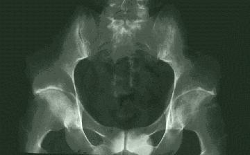 A 21-year-old with evidence of sacroiliitis on