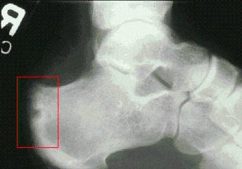 Erosion in the right heel was noted