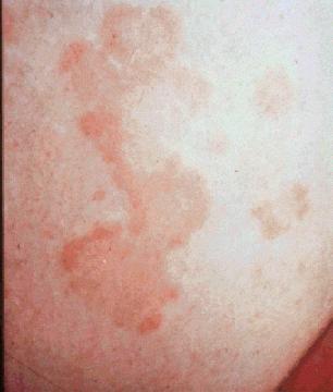 Typical rash of erythema marginatum in a child with acute rheumatic fever.