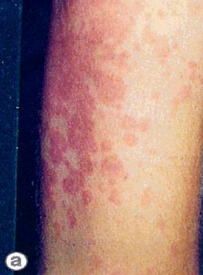 The rash of systemic onset JCA.