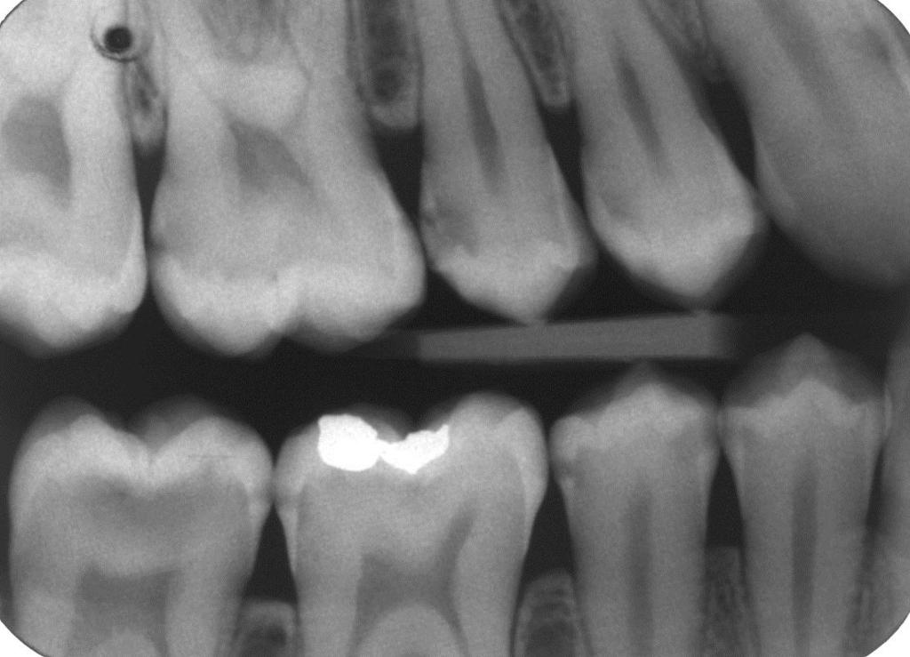 Caries detection Bitewing radiography: Proximal caries: Mean sensitivity 50% Mean specificity 87% Occlusal caries: Mean sensitivity 39%