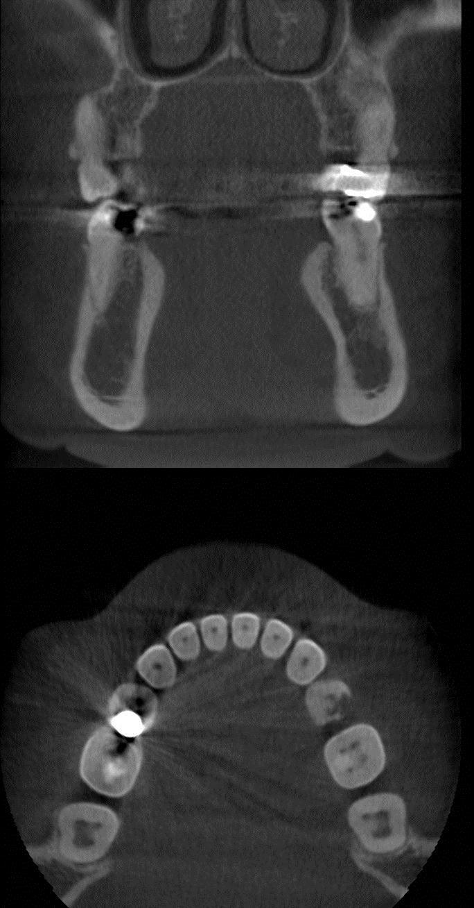 Caries detection: CBCT CBCT is not indicated