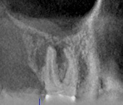 Endodontics CBCT is not indicated as a standard method for demonstration of root canal