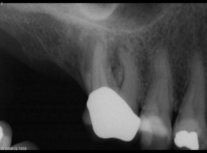cases, where intraoral radiographs provide information on root canal anatomy which is