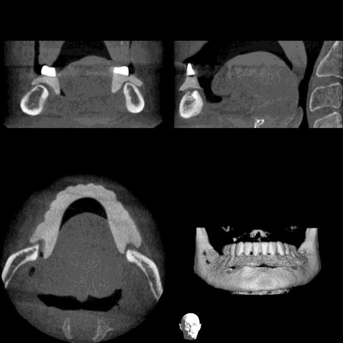 Implantology CBCT is indicated for crosssectional imaging prior to implant placement as an