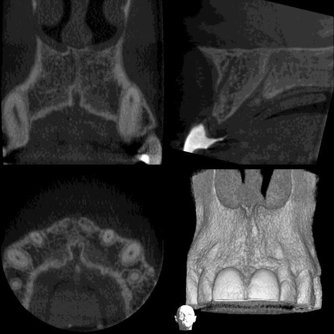 Implantology For cross-sectional imaging prior to implant placement, the advantage of CBCT with adjustable fields of view, compared with