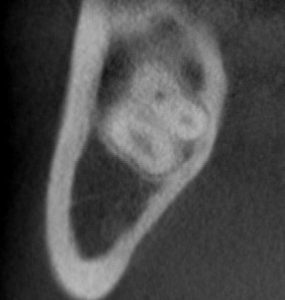 on lower third molar and ID canal