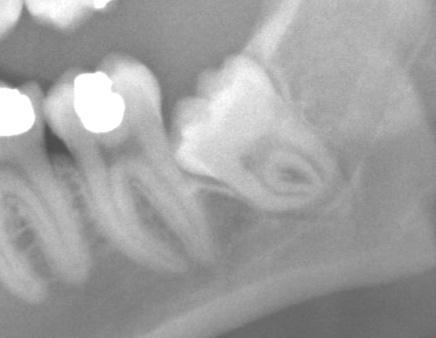 Third molars Factors associated with post-operative dysaesthesia Darkening of