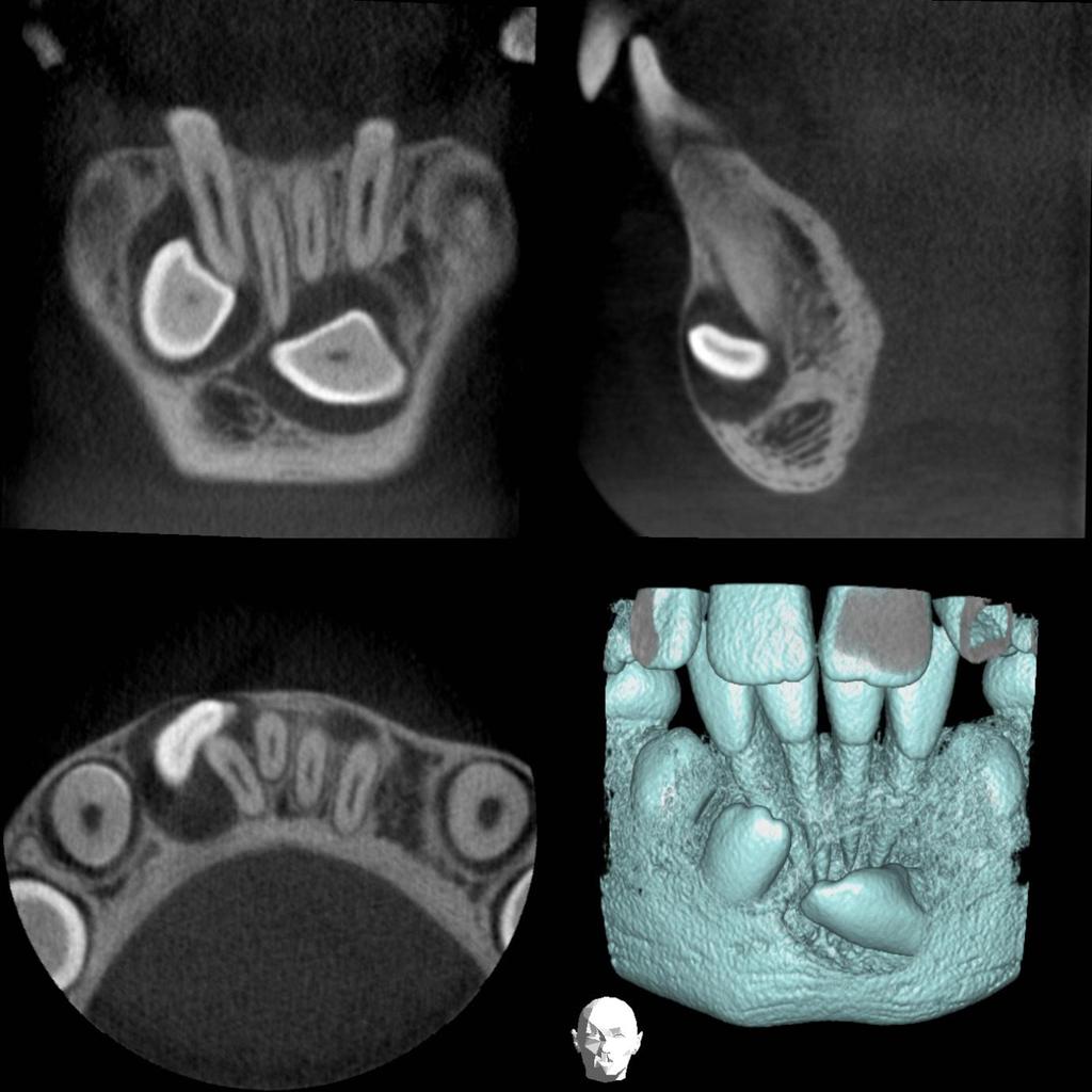 CBCT may be indicated for the localised assessment of an impacted tooth