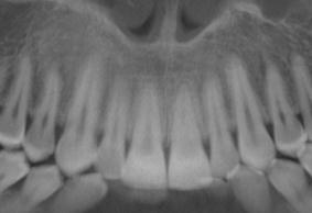 Van Elslande et al (2010) Am J Orthod Dentofacial Orthop 137(4