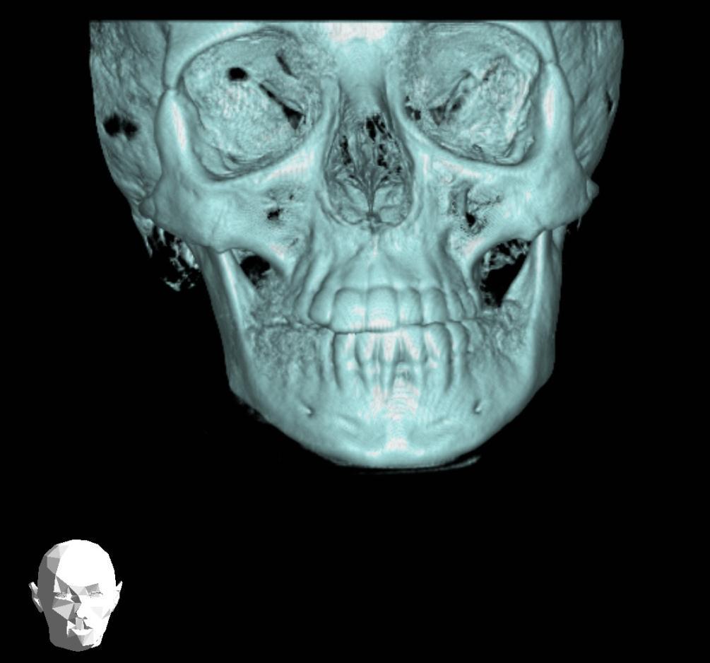Large volume CBCT should not be used routinely for orthodontic diagnosis GP For complex cases of skeletal abnormality, particularly those requiring combined