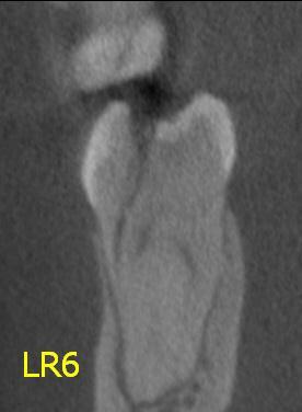 2009) High resolution CBCT important