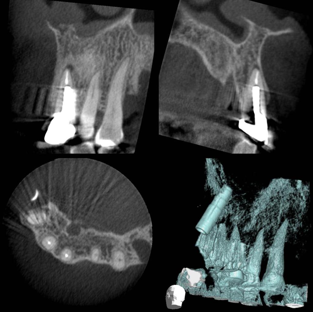 Dento-alveolar trauma