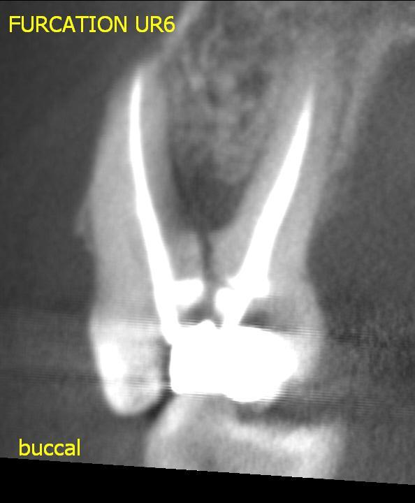 Dento-alveolar trauma Limited volume, high resolution CBCT is