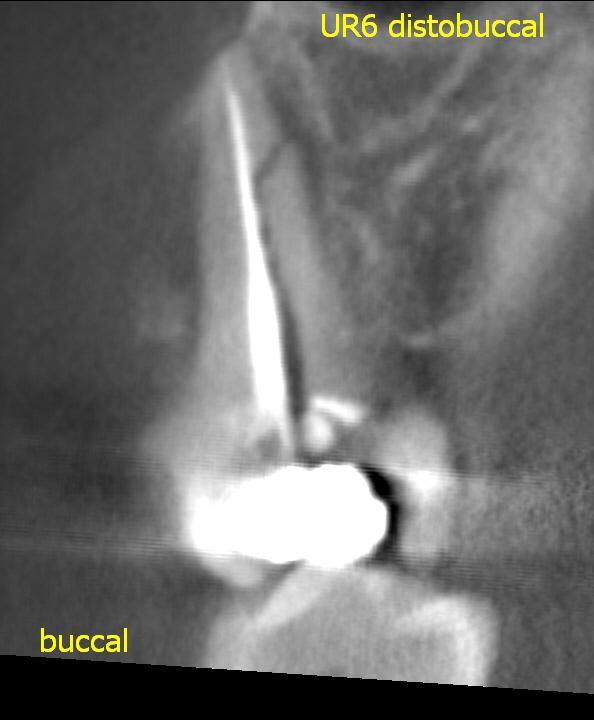 fracture) in selected cases, where conventional intraoral