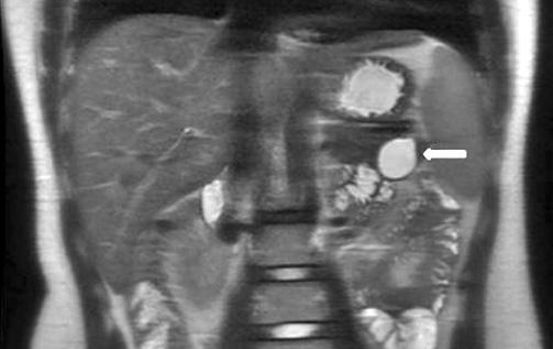 76 Korean J Hepatobiliary Pancreat Surg Vol. 16, No. 2, May 2012 Fig. 2. Computed tomography of the abdomen shows a circumscribed 3.