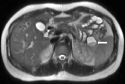 Magnetic resonance image (MRI), including vertical and horizontal sections. The cystic mass shows a fluid level and high-signal intensity on the T2-weighted image (arrows).