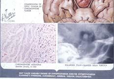 Lesions Tumors Embryonic