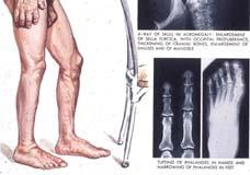 Acromegaly Growth hormone excess after closing of