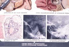 Ischemia Benign adenoma destroying gland