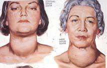 recognize early Hypothyroidism Tumors