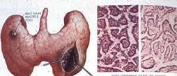 Malignancies of Thyroid Origin Arising from
