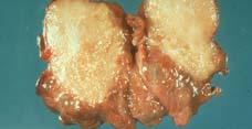 Very aggressive tumor Papillary Carcinoma