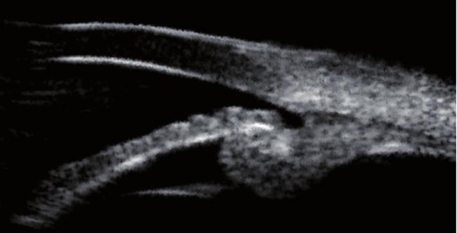 Fig. 2. Anterior position of ciliary processes relative to the scleral spur, but the angle remains open, resulting in a plateau iris anatomy without a plateau iris mechanism. Fig. 3.