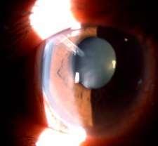 (GSL) Glaucoma