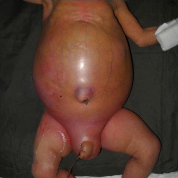 ISSN 2231-4261 CASE REPORT Urinary Ascites in Newborn A Rare Case Report Suryakant Y.
