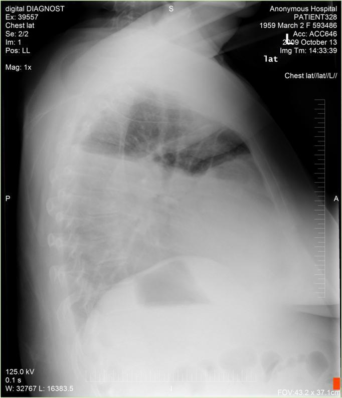 showing right-sided pleural
