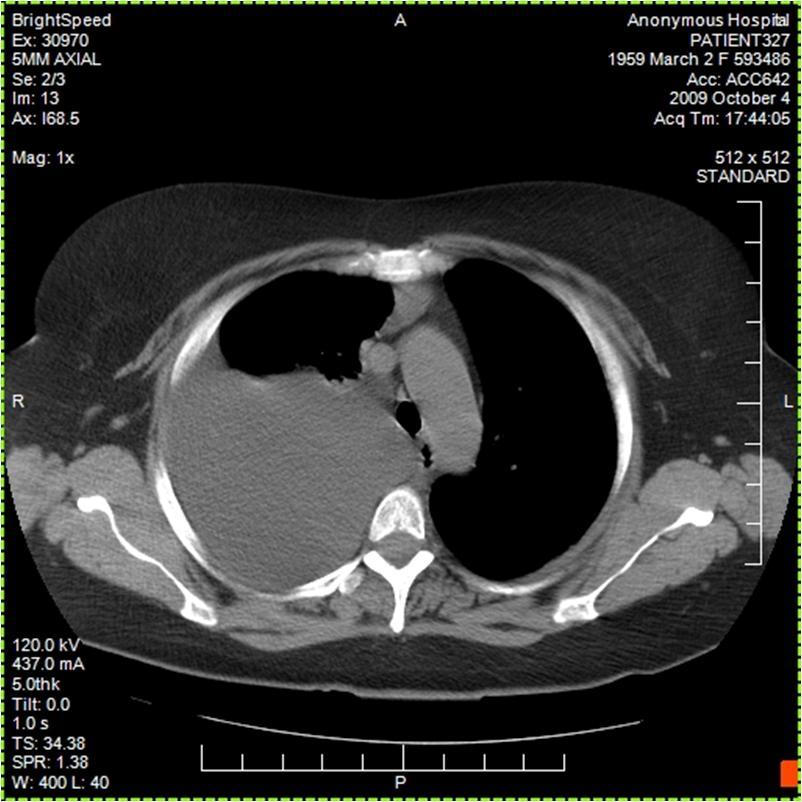 FIGURE 3. Axial thoracic CT showing right-sided pleural effusion. these diaphragmatic defects[1,2,10]. This same mechanism can also be applied to hepatic hydrothorax without ascites.