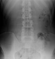 edu No Disclosures 34-year-old male with acute abdominal pain Normal obstruction series Now what?