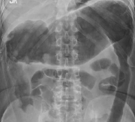Lead pipe Colon Term used to describe complete loss of normal haustration Presumably due to alterations in