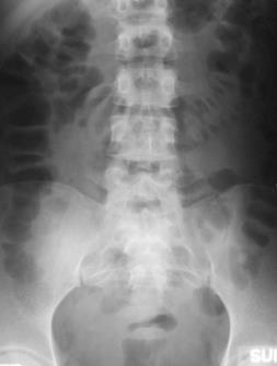 Normal Gas Pattern Distinguishing Large and Small Bowel Stomach Almost always has air Small Bowel Normal diameter ~ 3 cm Large Bowel Almost always has air in rectum or sigmoid Normal diameter ~ 6 cm