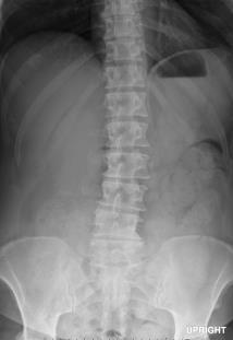 cm long Large Bowel Usually none Abnormal Bowel Gas Patterns Ileus Small and large bowel obstruction Volvulus 3 Questions: 1) Is there gas in the rectum or sigmoid colon?