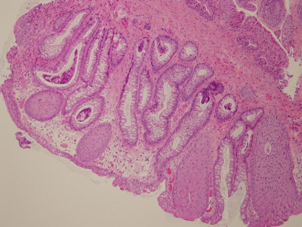 Cloacogenic polyp Bundles of muscularis