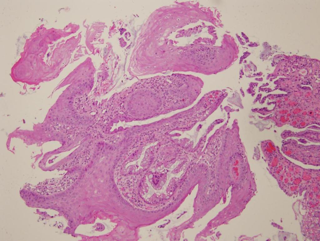 epithelium, Colorectal mucosa Squamous