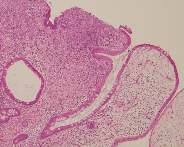 Histology subepithelial mixed inflammation; intact