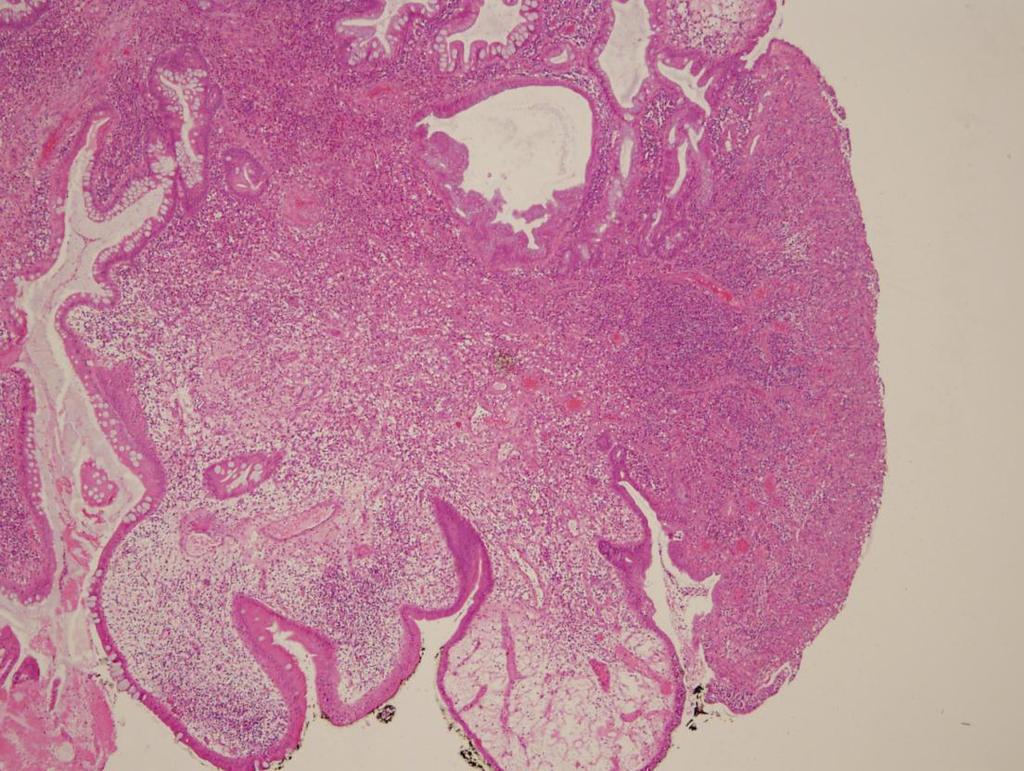 malignancy Typical cap -polyps, often encountered