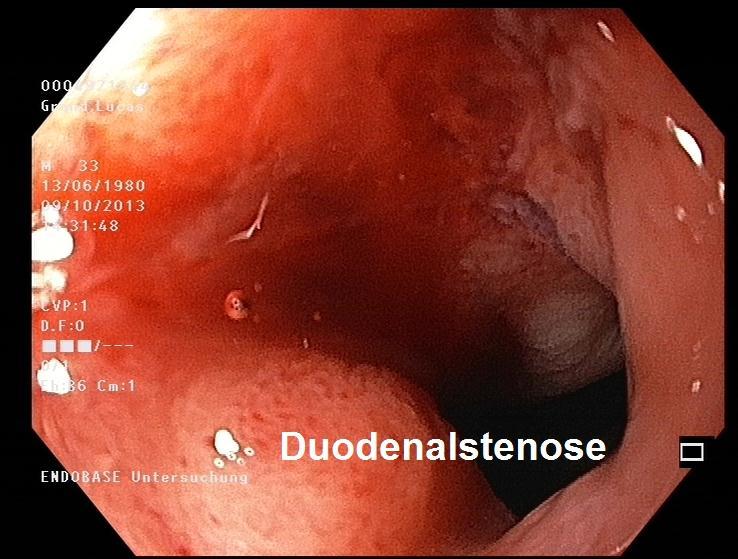 stenosis in the