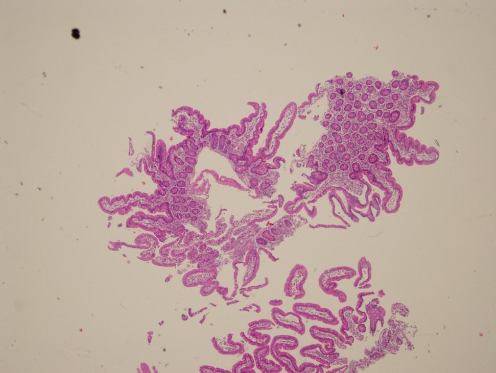 Histology Hyperplasia Brunner glands,