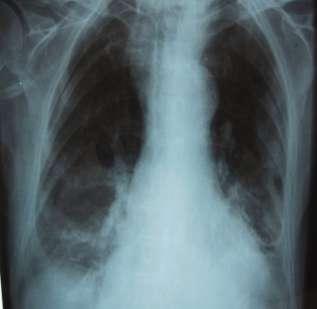 d) Aspiration Pneumonia in Older Adults. 139 elderly patients admitted for pneumonia.