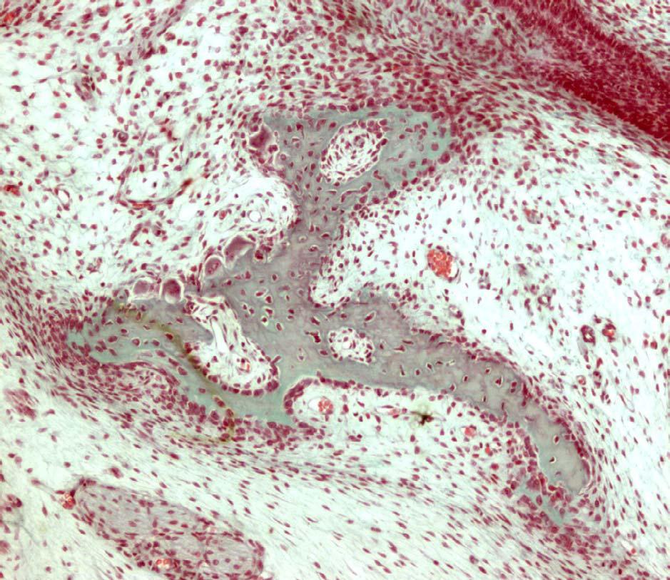 Intramembranous ossification Newly formed