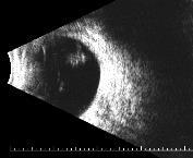 Lymphoma Summary Ocular ultrasound