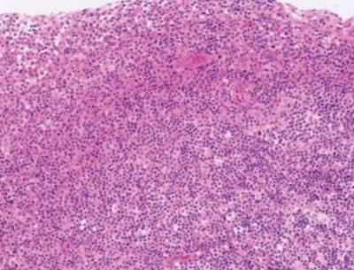 as extranodal marginal zone B-cell lymphoma of MALT type. General physical examination of the patient showed no abnormality. There were no lymphadenopathies or hepatosplenomegaly.