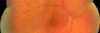 choroidal tumor in adults Women=Breast, lung, unknown