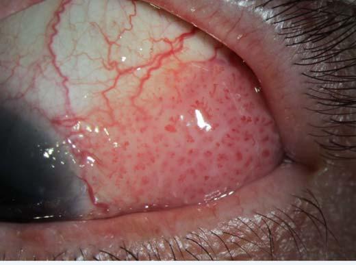 Diagnosis: Ocular Adnexal Lymphoma Low grade Non-Hodgkins B-cell